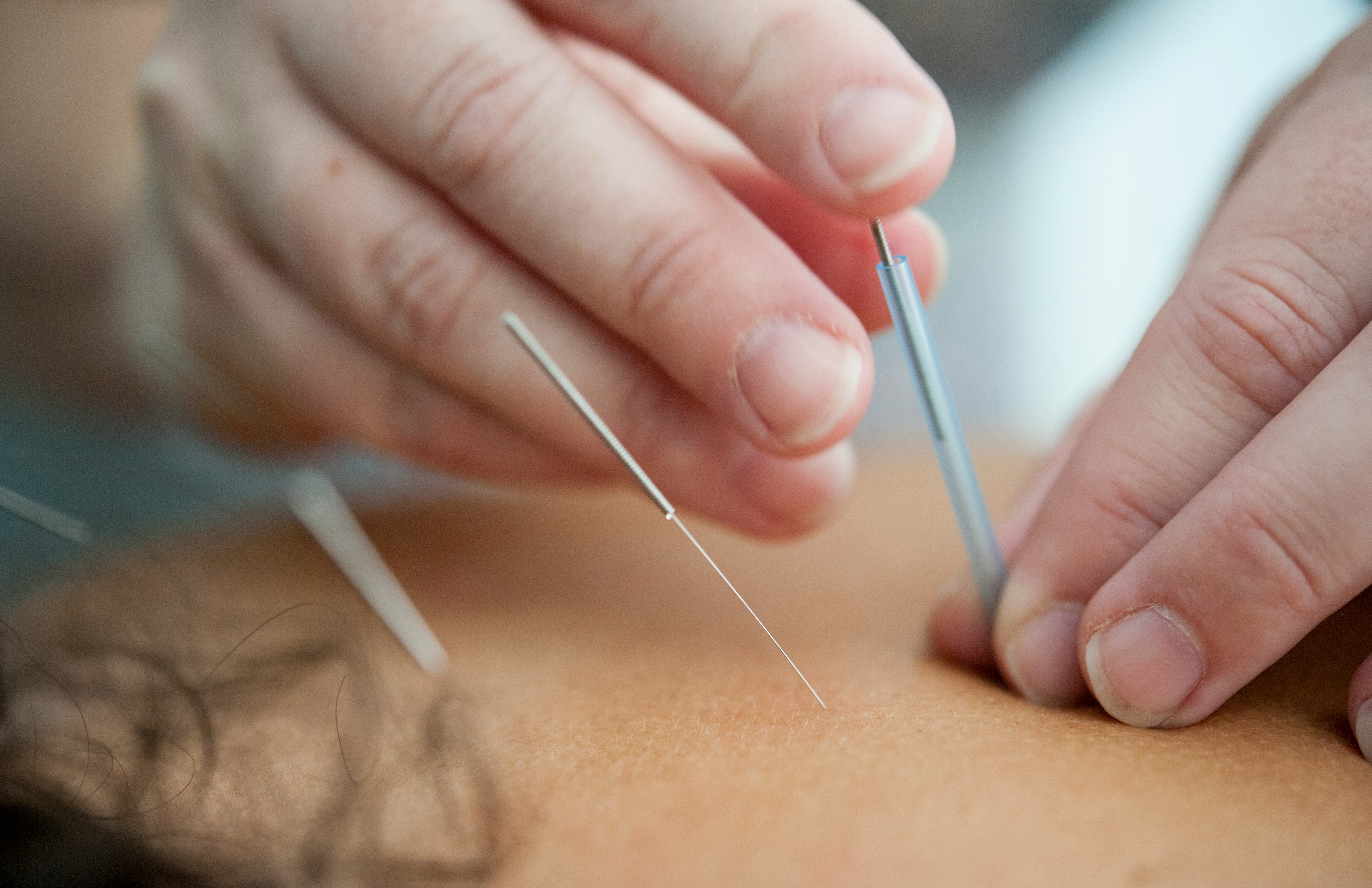 Acupuncture needle close-up