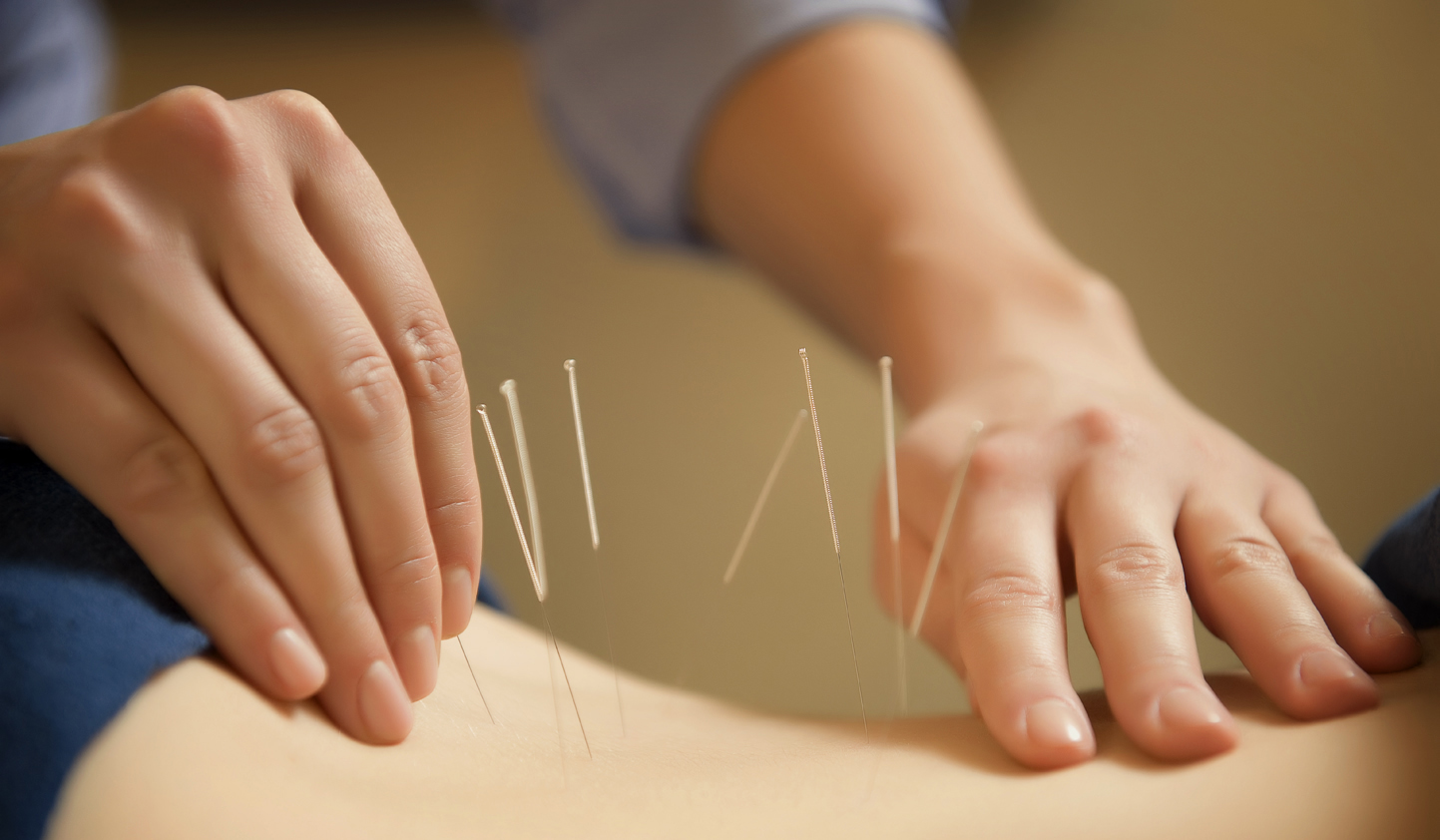 Hands applying acupuncture needles