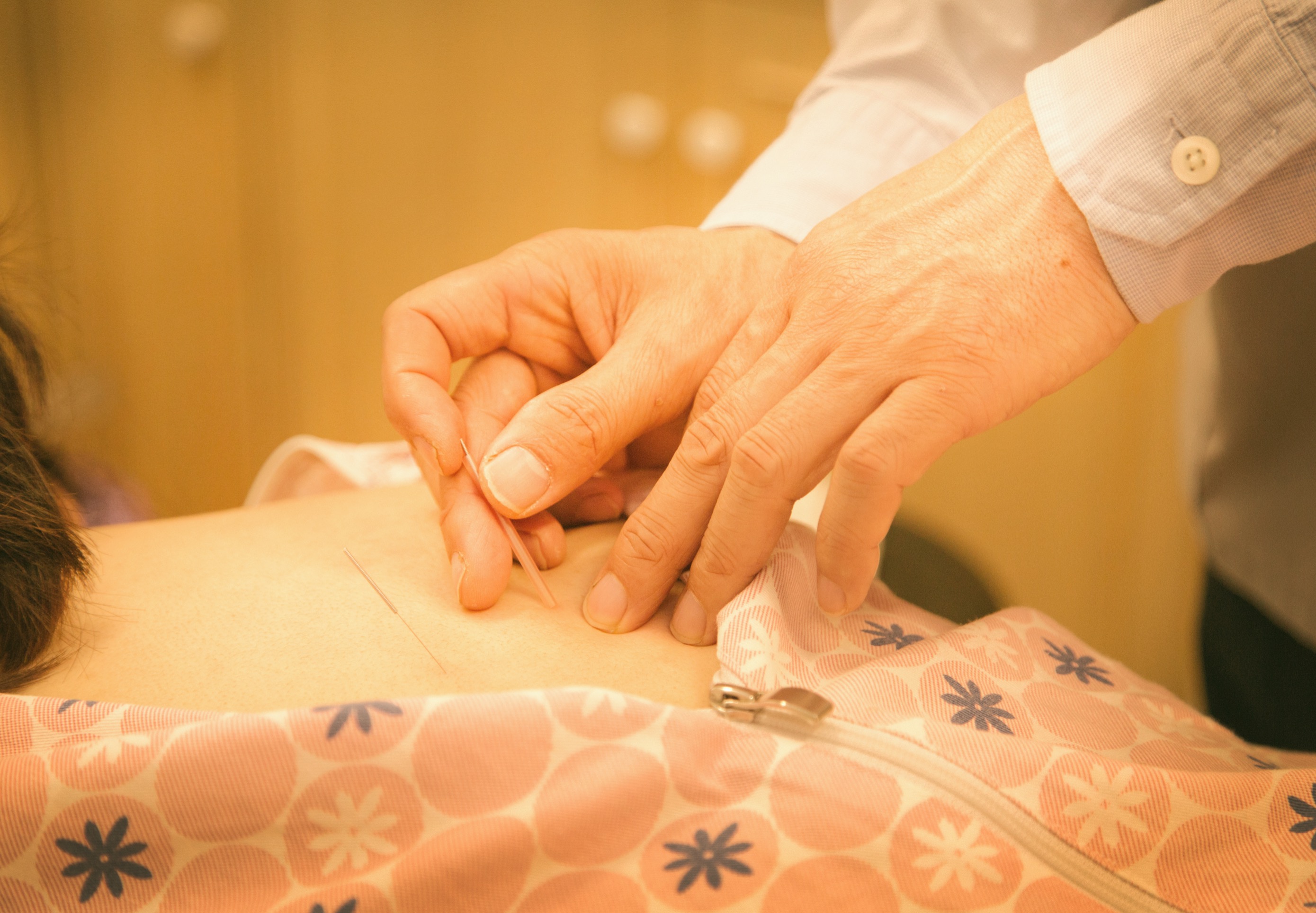 Cupping treatment close-up